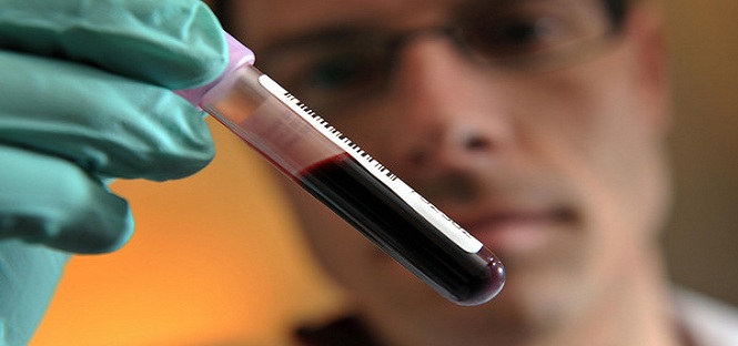Università di Firenze su cancro al colon: “Un test del sangue può predire se il malato può sopravvivere”