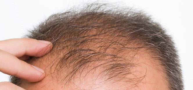 Il trapianto di nuovi follicoli di capelli umani come cura della calvizie: ecco il risultato di una ricerca americana