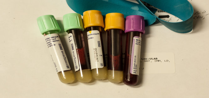 test del sangue prevede morte entro cinque anni